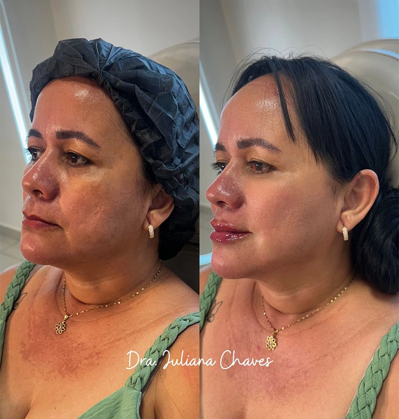ANTES E DEPOIS 1 - DRA JULIANA CHAVES