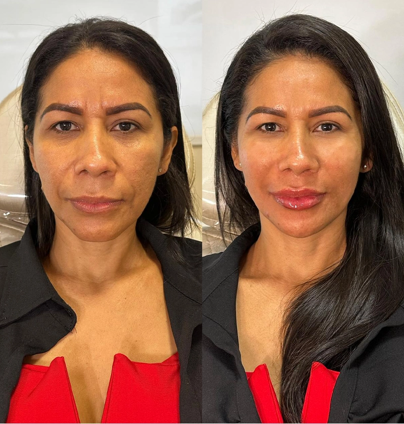 ANTES E DEPOIS 2 - DRA JULIANA CHAVES