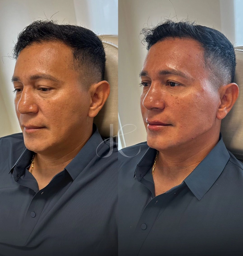 ANTES E DEPOIS 3 - DRA JULIANA CHAVES